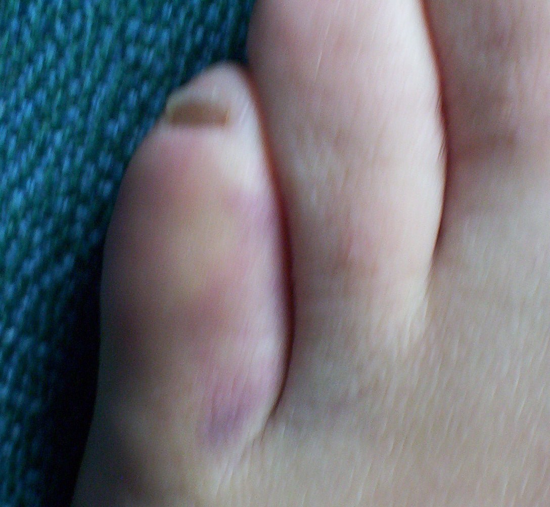 Pod's bruised toe. Akrigg must be happy about that.
